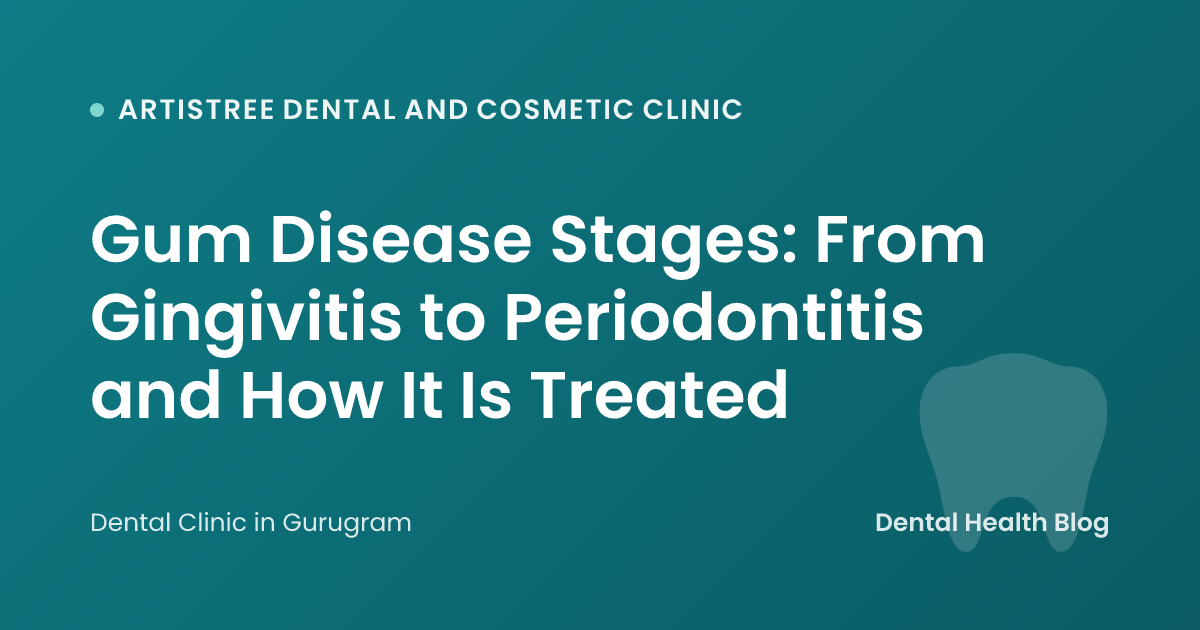 Gum Disease Stages: From Gingivitis to Periodontitis and How It Is Treated