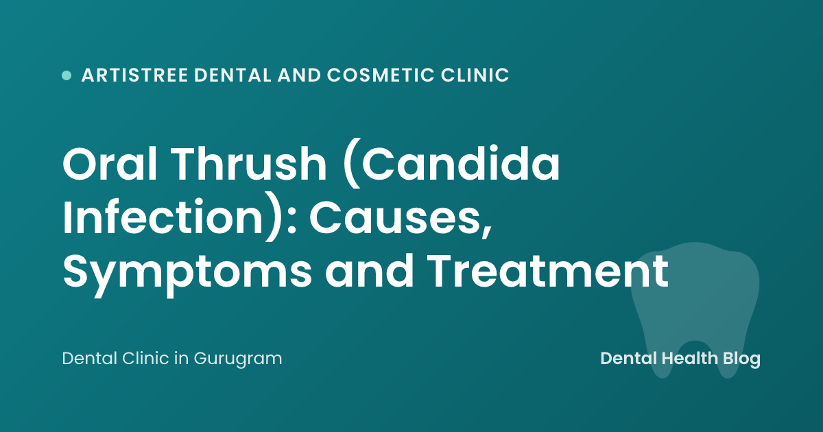 Oral Thrush (Candida Infection): Causes, Symptoms and Treatment