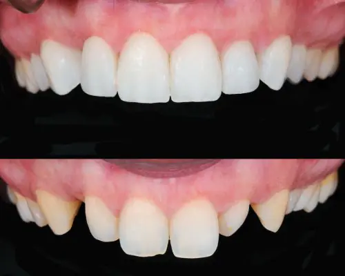 Smile Designing