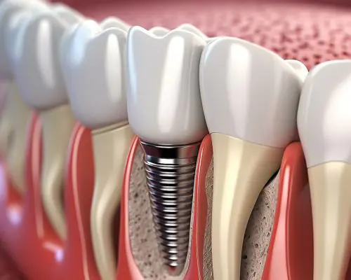 Dental Implants