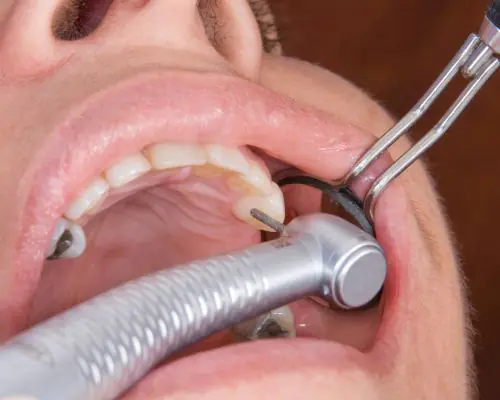 Full Mouth Rehabilitation