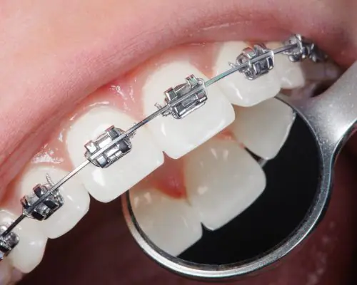 Orthodontic Treatment