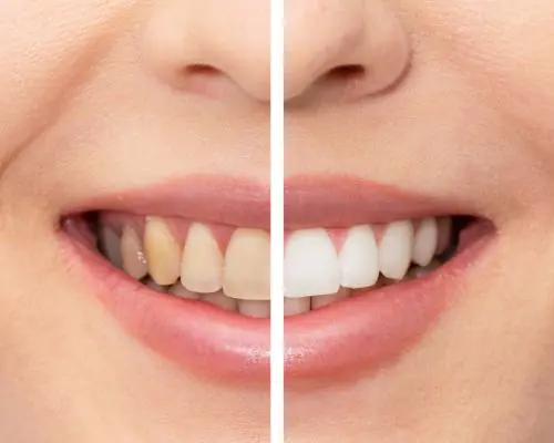Teeth Whitening