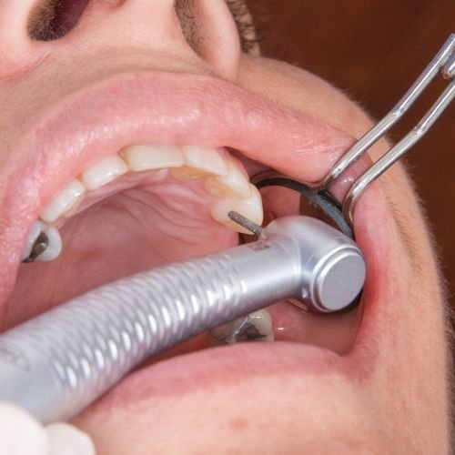 treatment for teeth with equipment