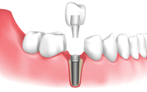 dental implants