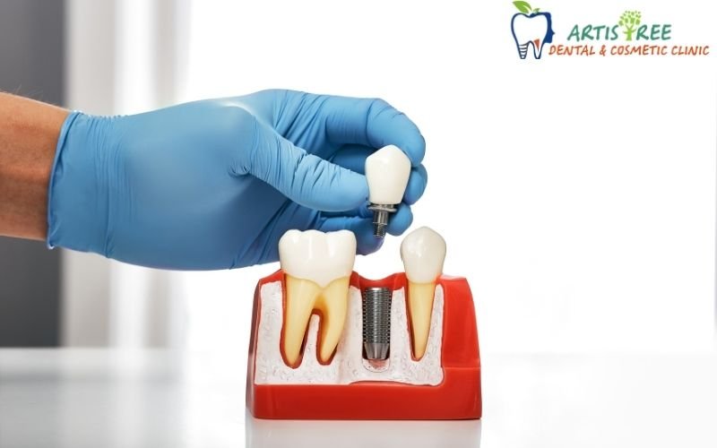 Dental Implants