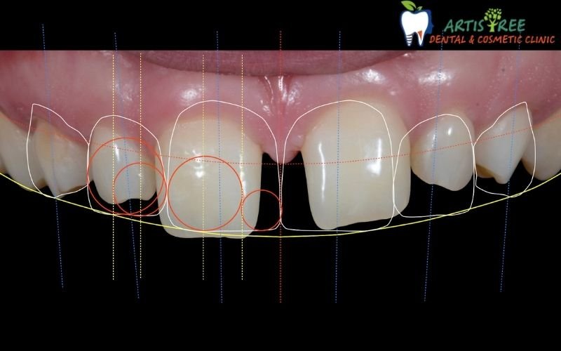 Smile Designing