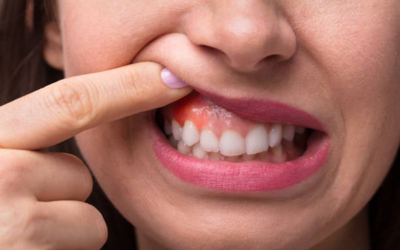 Gum Health
