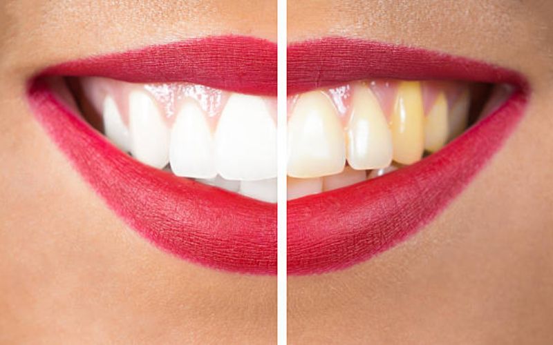 smile makeover in Gurgaon