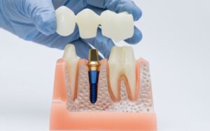 Dental Implants Safe