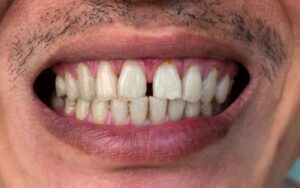 fix teeth gap