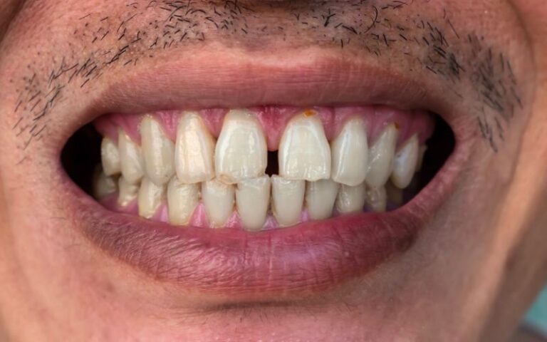 fix teeth gap