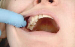 Hole in Tooth but No Pain