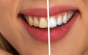 Teeth Whitening: In-Clinic vs. At-Home Kits — The Real Difference