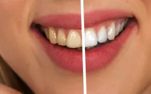 Teeth Whitening: In-Clinic vs. At-Home Kits — The Real Difference